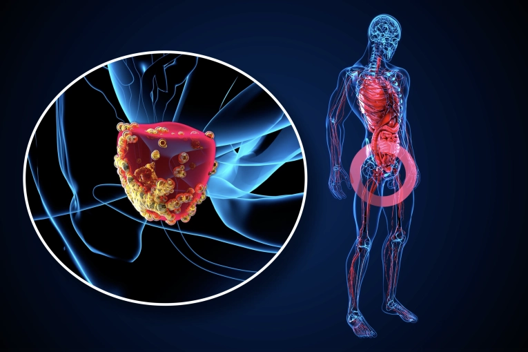Lanzan una campaña de prevención del cáncer de próstata destinada a hombres sin cobertura social - imagen de origen