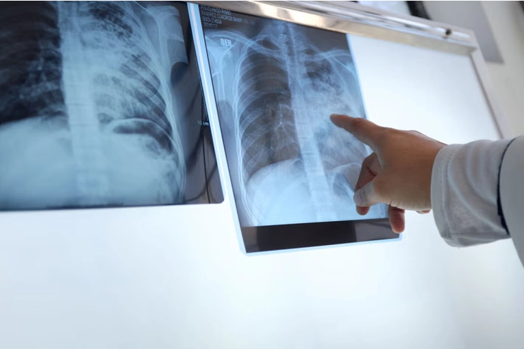 Entre Ríos registra un aumento del 39% en los casos de tuberculosis durante 2026 - imagen de origen