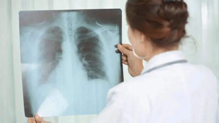 Entre Ríos registró un aumento del 38,8% en los casos de tuberculosis durante 2026 - imagen de origen