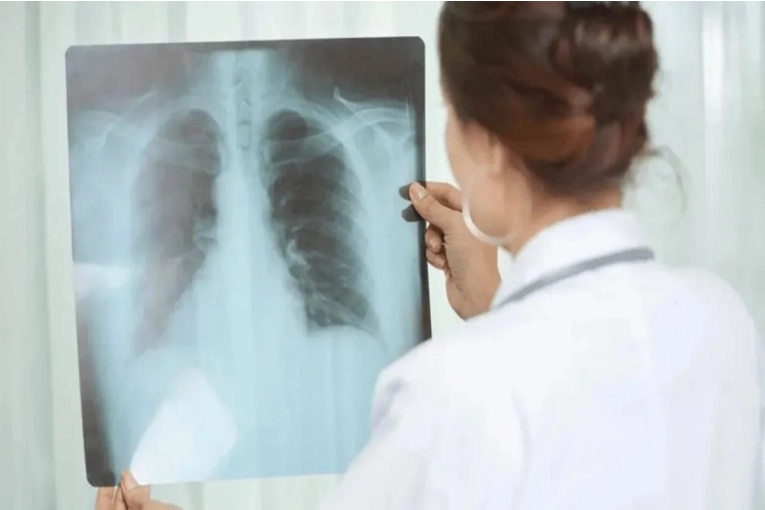 Los casos de tuberculosis aumentaron en Entre Ríos casi un 39% en lo que va de 2026 - imagen de origen