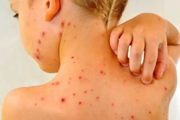 Alerta epidemiológica en Entre Ríos: Los casos de varicela aumentan con fuerza en los departamentos Tala y Federal - imagen de origen