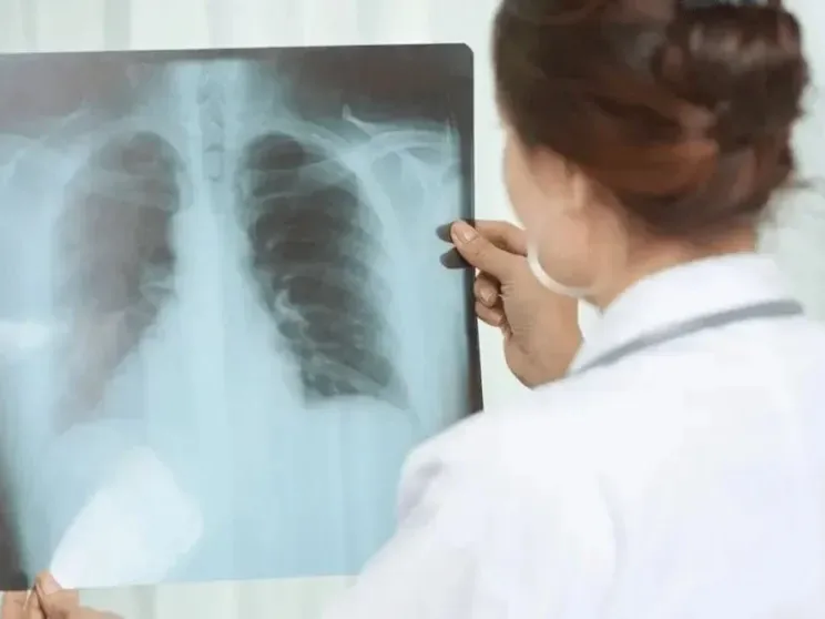 Alerta sanitaria: Los casos de tuberculosis aumentaron casi un 39% en lo que va de 2026 - imagen de origen