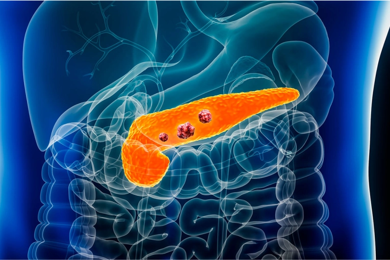 Un nuevo fármaco logró duplicar la supervivencia en cáncer de páncreas - imagen de origen