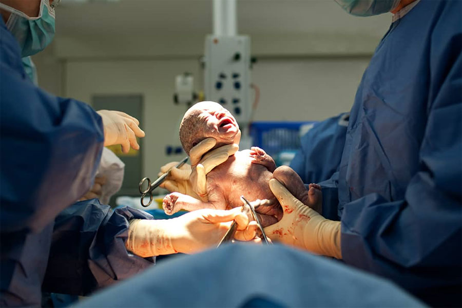 En Argentina, más del 40% de los nacimientos ocurre por cesárea, triplicando lo recomendado por la OMS - imagen de origen