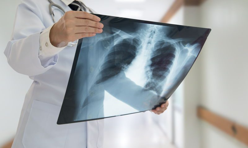 Tuberculosis: advierten sobre el aumento de casos en Gualeguaychú al igual que en el resto del país - imagen de origen